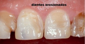 dientes erosionados